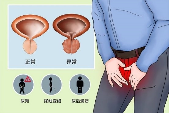 国内首个良性前列腺增生复方制剂上市