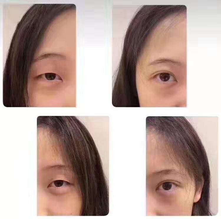 口碑佳的开扇形双眼皮机构行业口碑汇总
